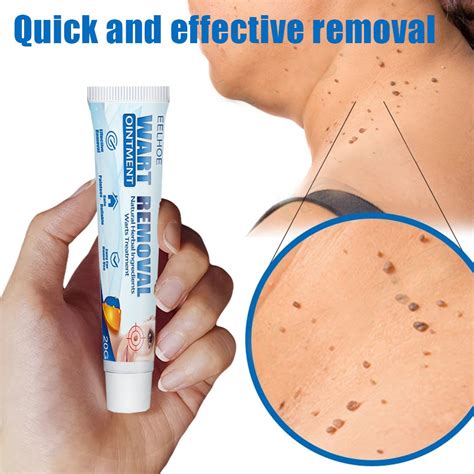 Local Delivery Eelhoewarts Remover Original Cream Wart Remover