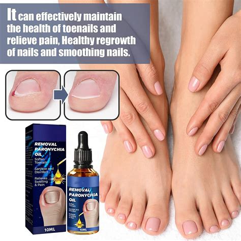 German Toenailcare Removal Paronychia Oil Anti Paronychia Relief Oil