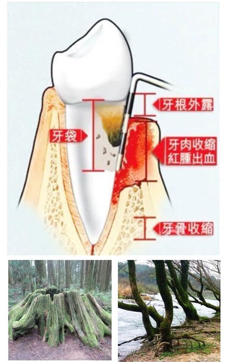 洗牙會讓牙縫變大、牙齒鬆動？這樣做對口腔傷害極大 每日頭條