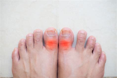 Hallux Rigidus Ursachen Behandlung Der Gelenkversteifung