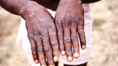 Monkey Pox Monkeypox Can Be Stopped In Non Endemic Countries If