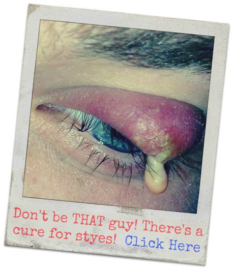 Best Stye Medicine Antibiotics Otc Or Home Remedies