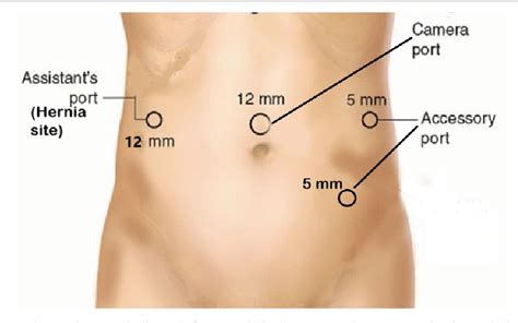 Figure From Trocar Site Herniation Tsh Of The Small Bowel Following