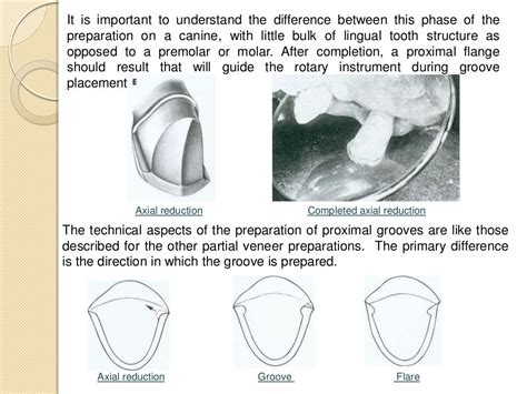 Preparation of partial veneer crown