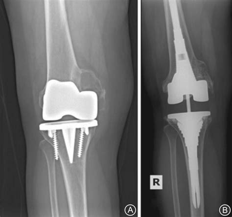 A Preoperative Anteroposterior Ap Radiograph Showing A Type Iia