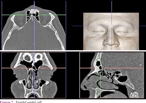 Figure From Frequency Of Frontal Cells According To The International