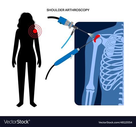 Shoulder Arthroscopy Poster Royalty Free Vector Image