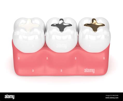 D Render Of Teeth With Gold Amalgam And Composite Inlay Dental