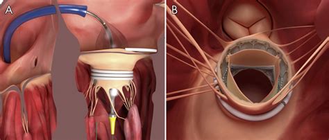 Transcatheter Mitral Valve Repair And Replacement Current Evidence For