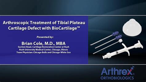 Arthrex Arthroscopic Treatment Of Tibial Plateau Cartilage Defect