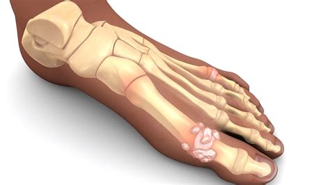 Ganglion Cyst in the Big Toe Joint [Causes, Symptoms & Best Treatment!]