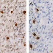 Immunohistochemistry Of CD163 And CD68 Identification Of Macrophages