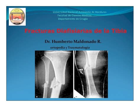 Pdf Fracturas Diafisiarias De La Tibia Pptx Pdfslide Net