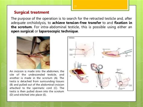 Undescended Testis Cryptorchidism