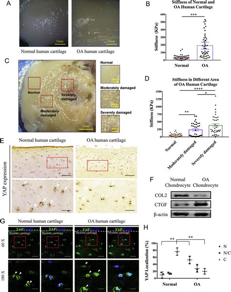 Human Cartilage ECM Stiffening And YAP Activation In Clinical OA