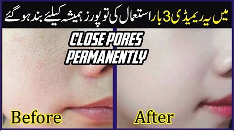 Open Pores Home Remedy How To Get Rid Of Open Pores On Face Hoor