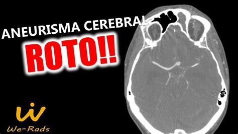 Aneurisma cerebral roto na tomografia de crânio YouTube