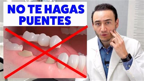 Puente Dental Antes Y Despues Actualizado Noviembre 2024