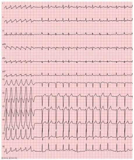 JCM Free Full Text Arrhythmic Manifestations Of Cardiac Amyloidosis