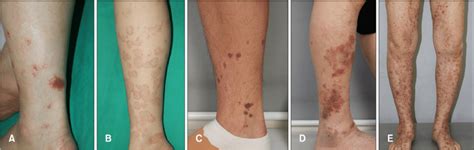 Clinical presentation and subtypes of pigmented purpuric dermatosis ...