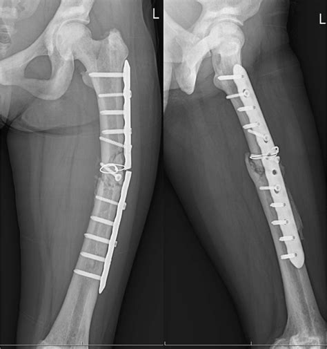 Recurrent Fracture At The Same Level Of The Left Femoral Shaft And