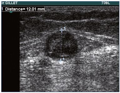 Management of superficial vein thrombosis of the lower limbs: update ...