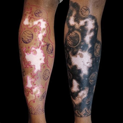 Does Vitiligo Affect Tattoos? (expert opinion) - Tattoo Twist