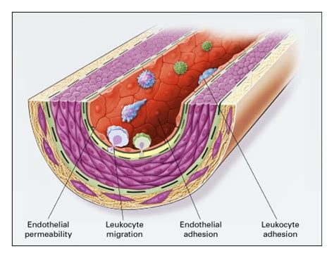 Atherosclerosis An Inflammatory Disease Nejm