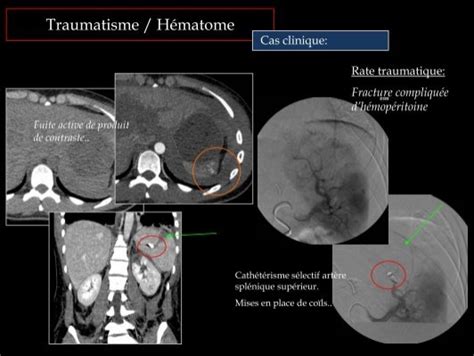 Traumatisme / Hématome
