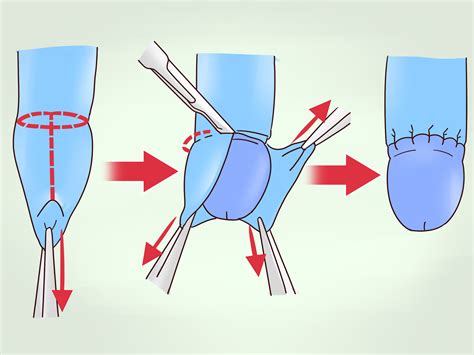 3 Ways To Do Phimosis Stretching WikiHow