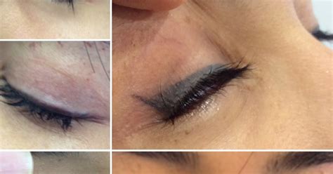 Eyeliner Tattoo Removal Process And Success