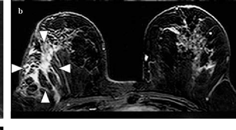 Multimodality Imaging Features Of Idiopathic Granulomatous Mastitis