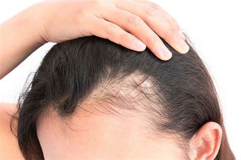 What Is Female Androgenetic Alopecia Insalaco Clinic