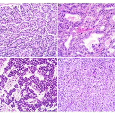 Uncommon Histological Features Of Pancreatic Acinar Cell Carcinomas