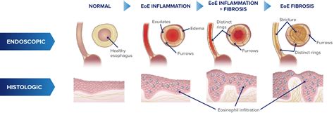 What Is Eosinophilic Esophagitis Eoe Symptoms Causes 43 Off