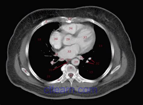 Anatomy CT Axial Chest