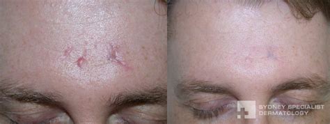 Conditions and Treatments | Surgical Scars | Sydney Specialist Dermatology