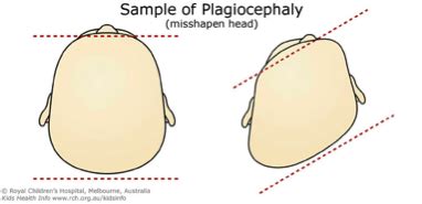 Plagiocephaly Update - Victorian Children's Clinic