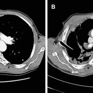 A The Anterior Chest Wall Abscess With A Skin Defect After Removal Of