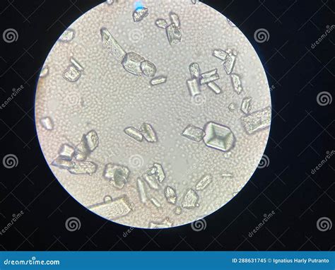 Microscopic View Of Struvite Crystals From Urinary Sediment Magnesium