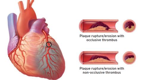 Pom Cards Acute Coronary Syndromes I Ii Flashcards Quizlet