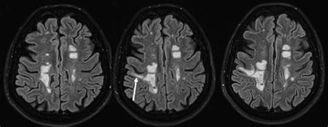 LEUCOENCEFALOPATIA MULTIFOCAL PROGRESIVA PDF