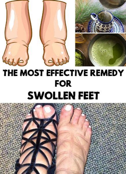 This Is The Most Powerful Natural Remedy For Swollen Legs Foot