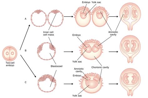 Monochorionic Twin Pregnancy— Potential Risks And Perinatal Outcomes