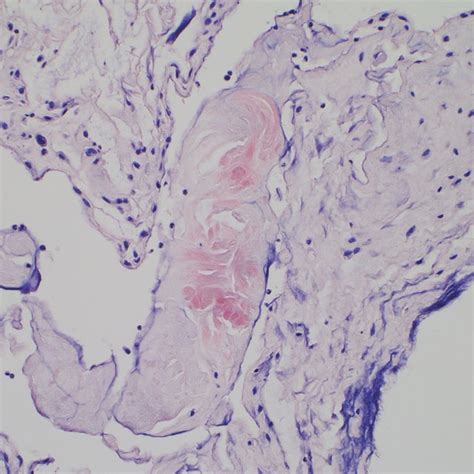 Positive Congo Red Stain Showing Apple Green Birefringence Of Amyloid