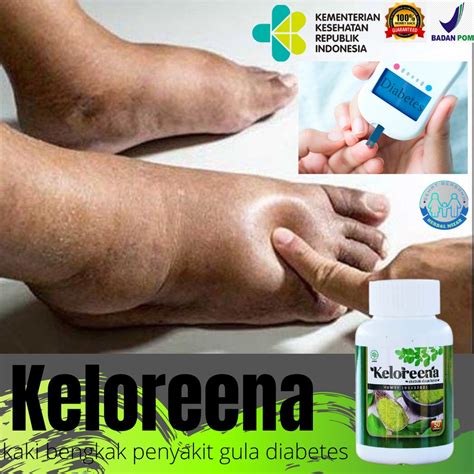 Jual Obat Kaki Bengkak Penyakit Gula Diabetes Asam Urat Rematik