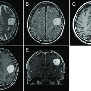 Axial T1 A And T2 Weighted B MRI Showing A Mass Lesion In The Left