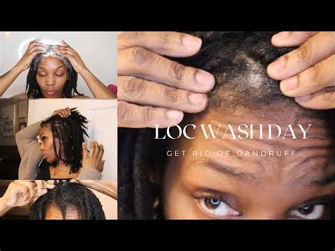 Dry Itchy Scalp Care On Locs How I Get Rid Of Dandruff Scales