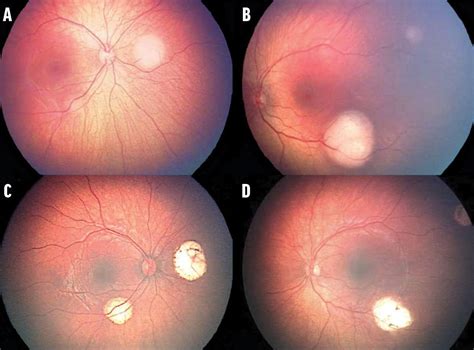 Trilateral Retinoblastoma With Suprasellar Mass Retina Today