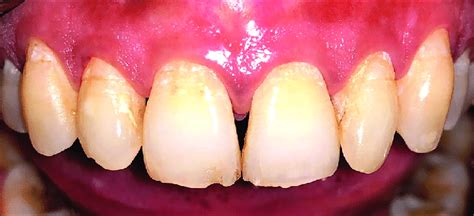 Pre Operative View Showing Loss Of Interdental Papilla In And